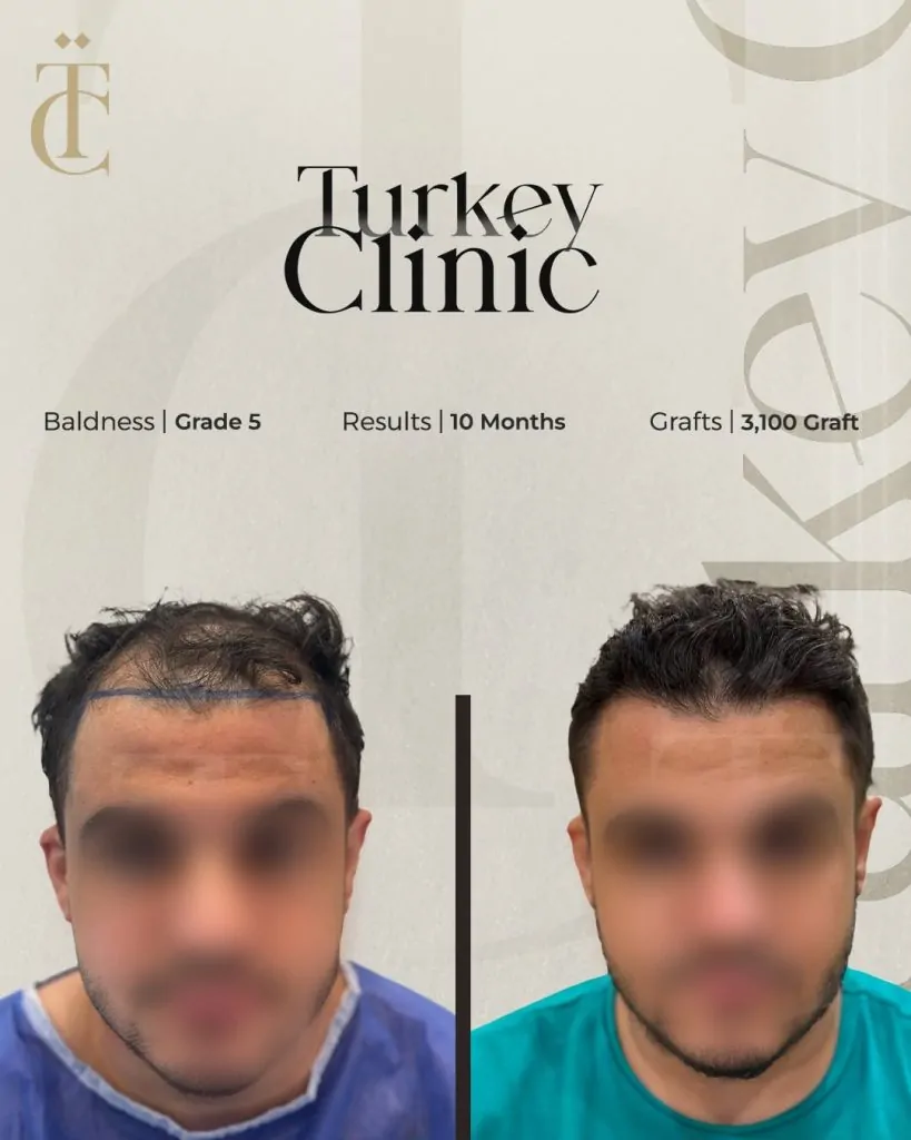 نتائج زراعة الشعر للصلع الوراثي الدرجة الخامسة بعد 10 أشهر 3100 بصيلة