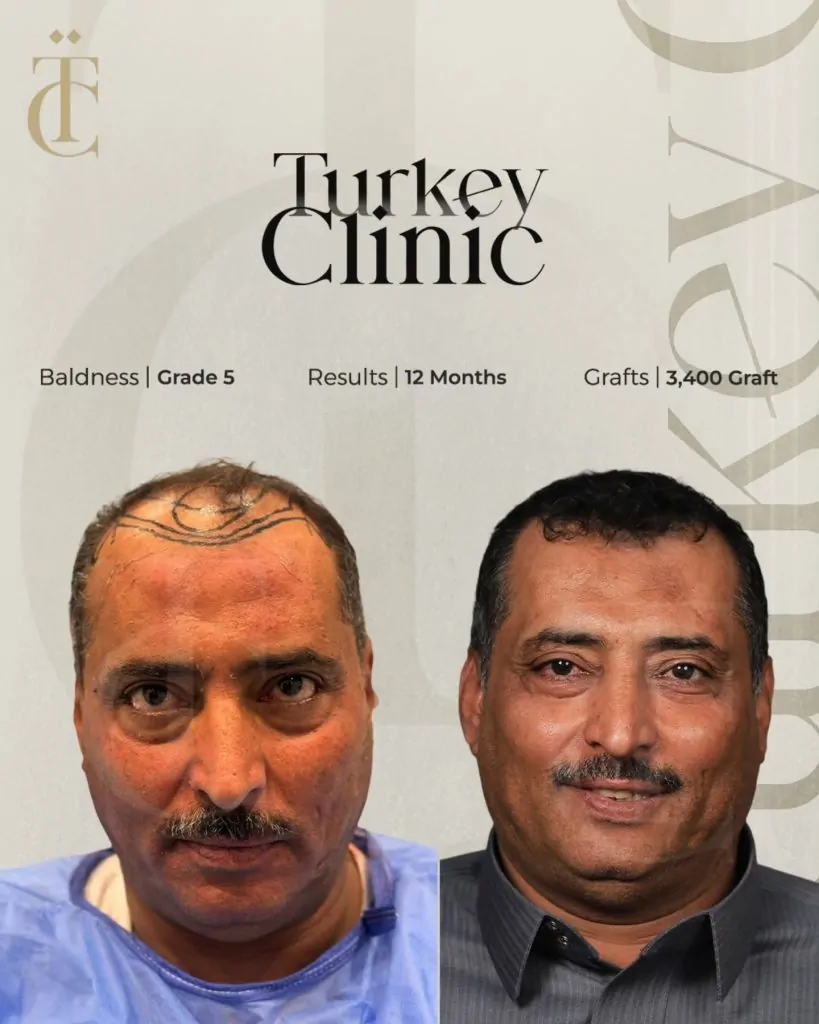 نتائج زراعة الشعر للصلع الوراثي الدرجة الخامسة بعد 12 شهرًا 3400 بصيلة