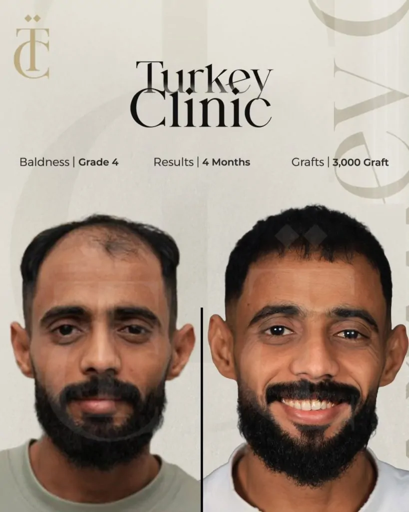 نتائج زراعة الشعر للصلع الوراثي الدرجة الرابعة بعد 4 أشهر 3000 بصيلة