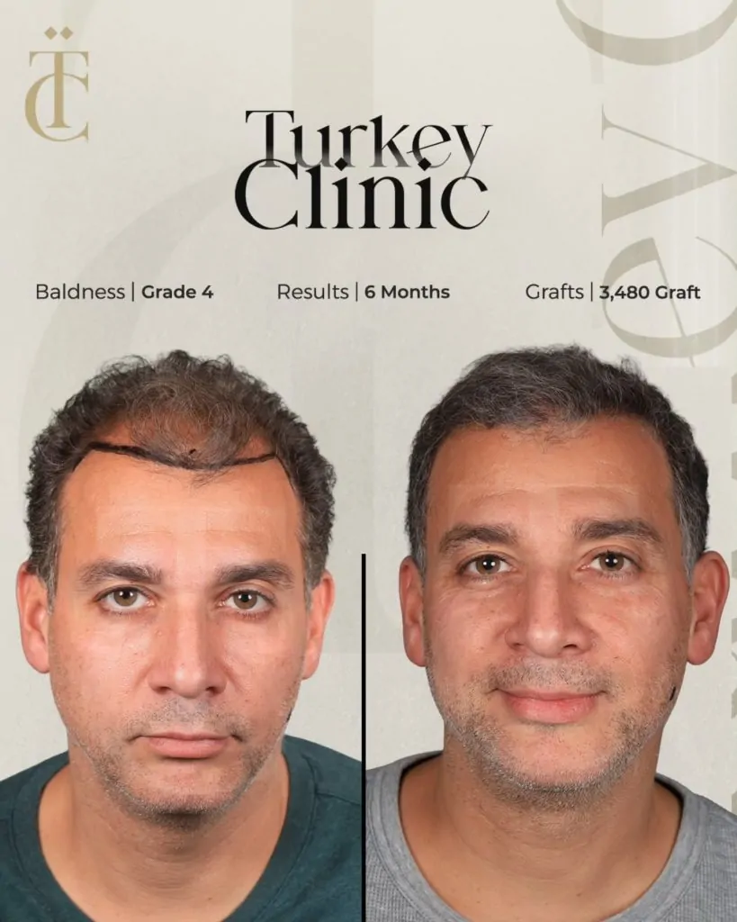 نتائج زراعة الشعر للصلع الوراثي الدرجة الرابعة بعد 6 أشهر 3480 بصيلة