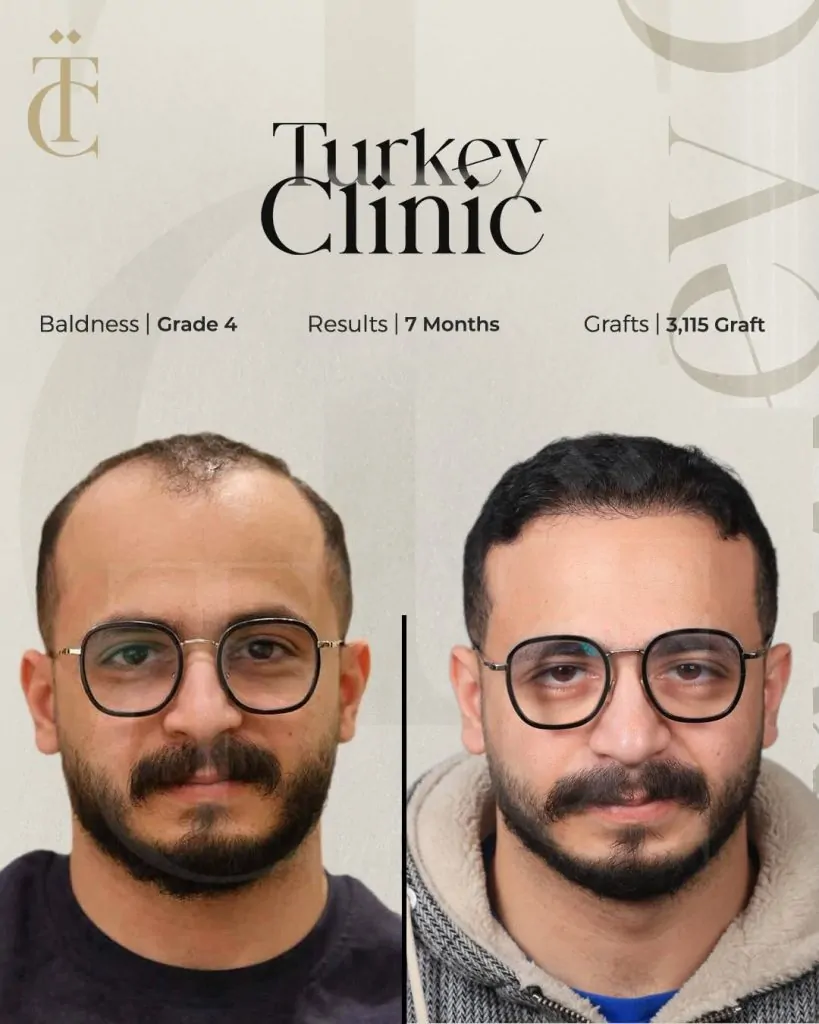 نتائج زراعة الشعر للصلع الوراثي الدرجة الرابعة بعد 7 أشهر 3115 بصيلة