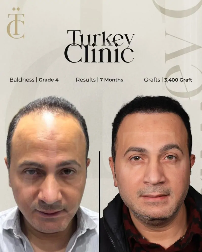 نتائج زراعة الشعر للصلع الوراثي الدرجة الرابعة بعد 7 أشهر 3400 بصيلة