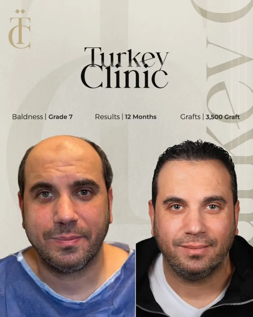 نتائج زراعة الشعر للصلع الوراثي الدرجة السابعة بعد 12 شهرًا 3500 بصيلة