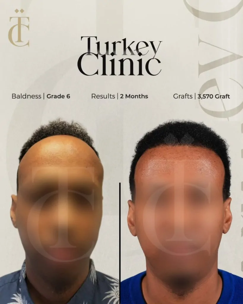 نتائج زراعة الشعر للصلع الوراثي الدرجة السادسة بعد شهرين 3570 بصيلة