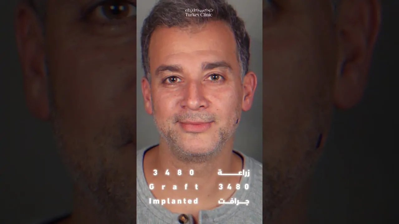 6 شهور بعد زراعة الشعر