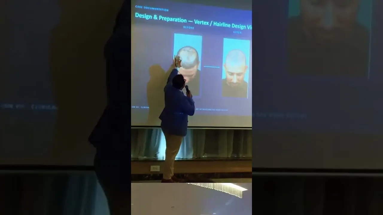 Hair Transplant Training