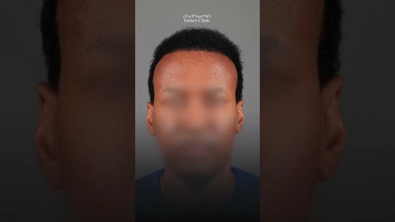 زراعة الشعر الأفرو