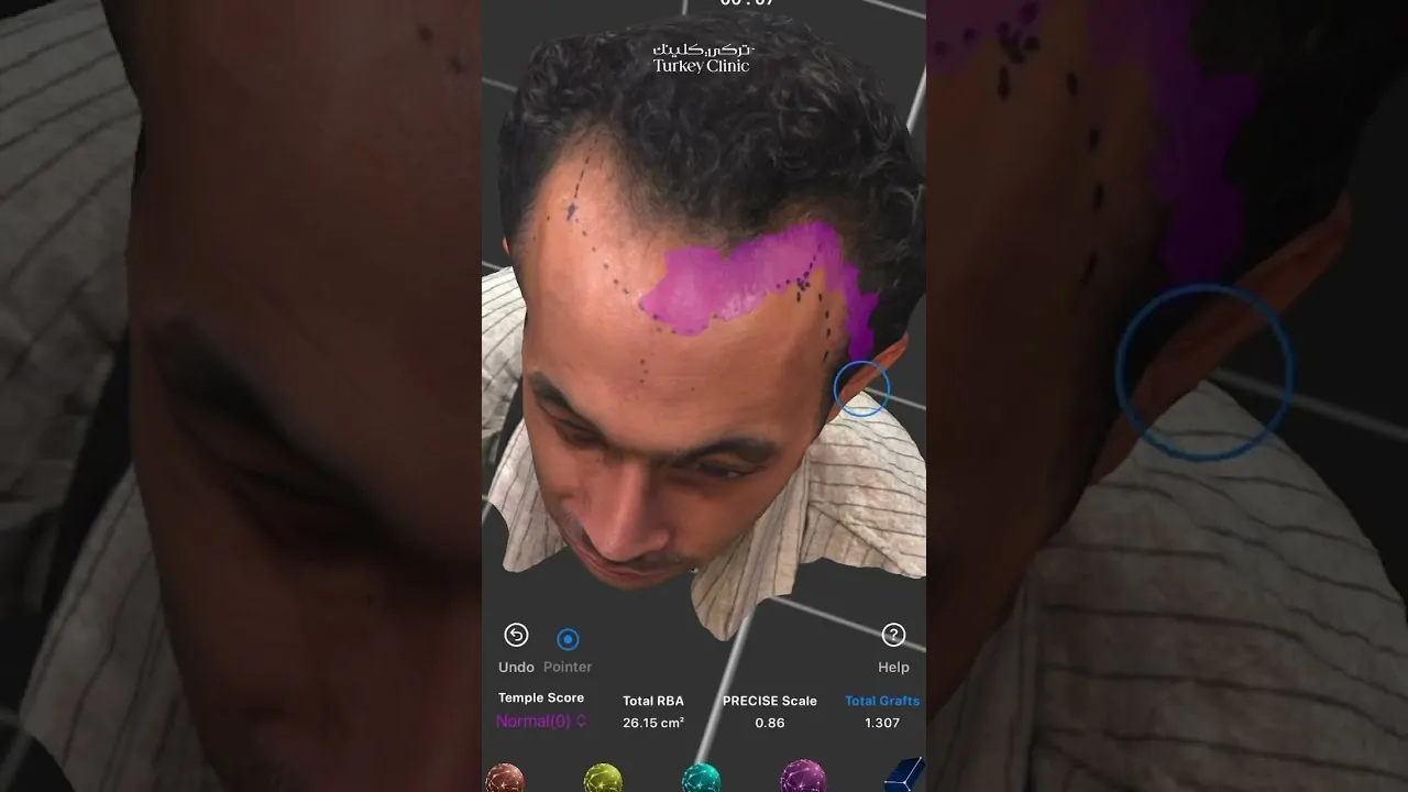 زراعة الشعر بالذكاء الاصطناعي