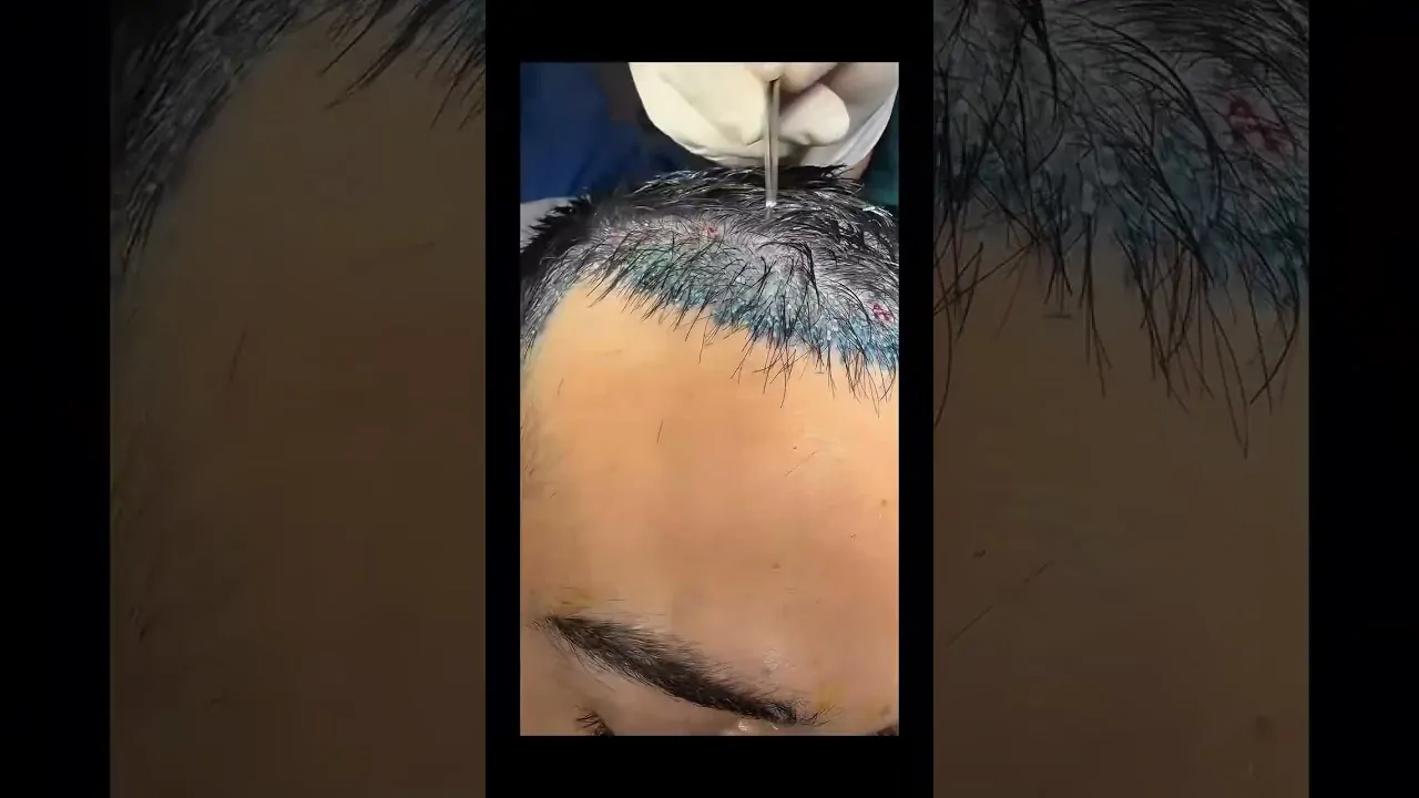 زراعة الشعر بدون حلاقة بالكامل