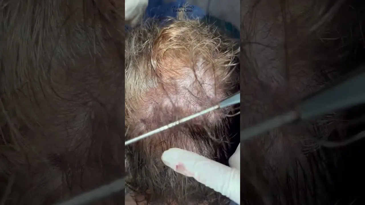 زراعة الشعر للسيدات بدون حلاقة