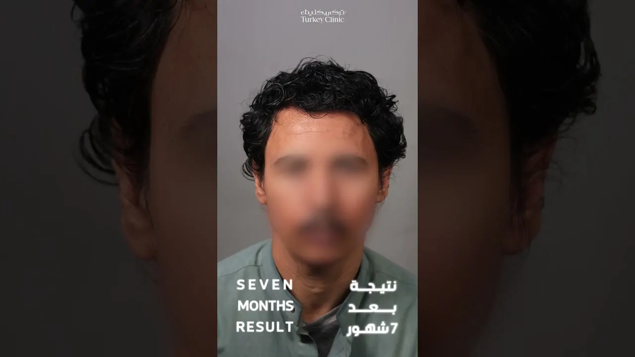 سر نتائج زراعة الشعر الطبيعية
