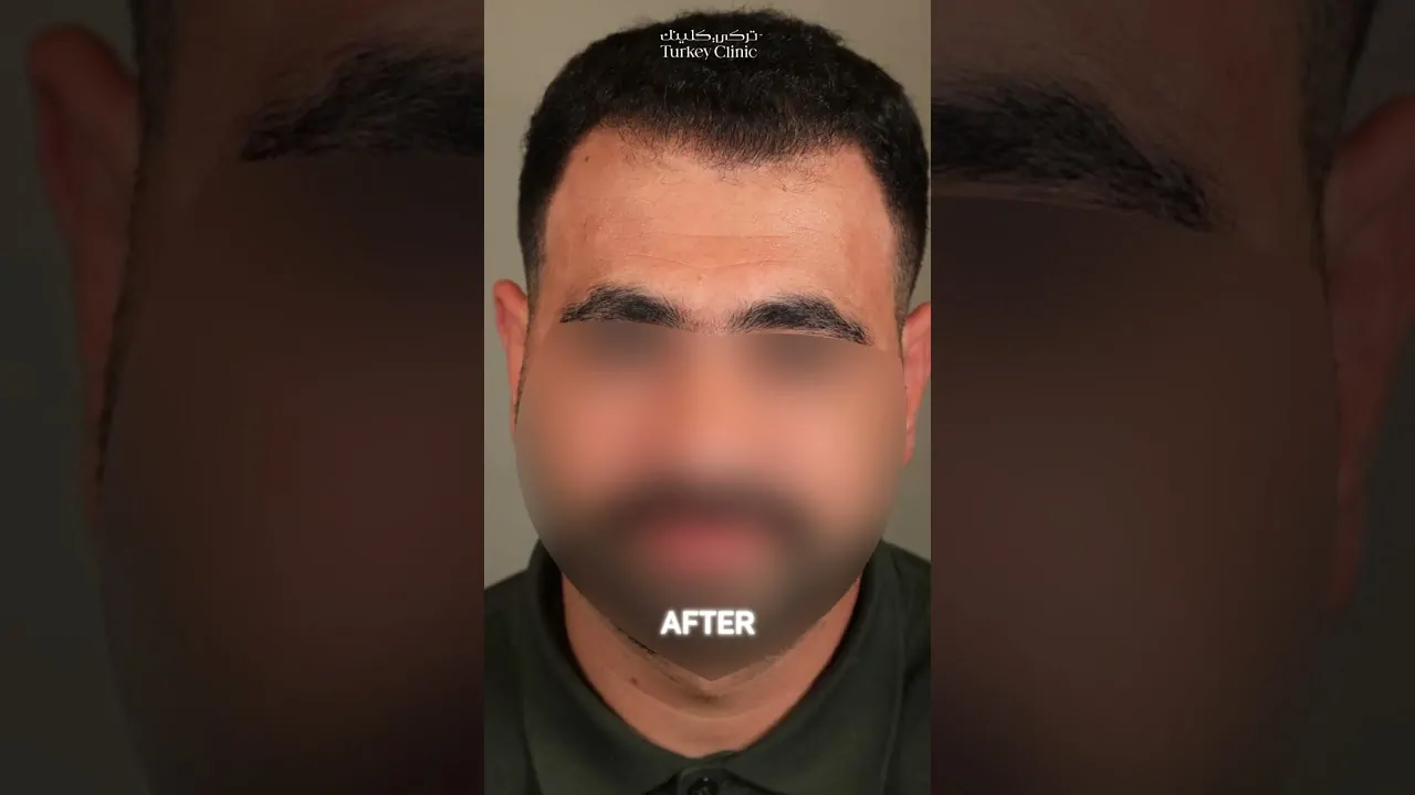 علاج الصلع من الدرجة الخامسة