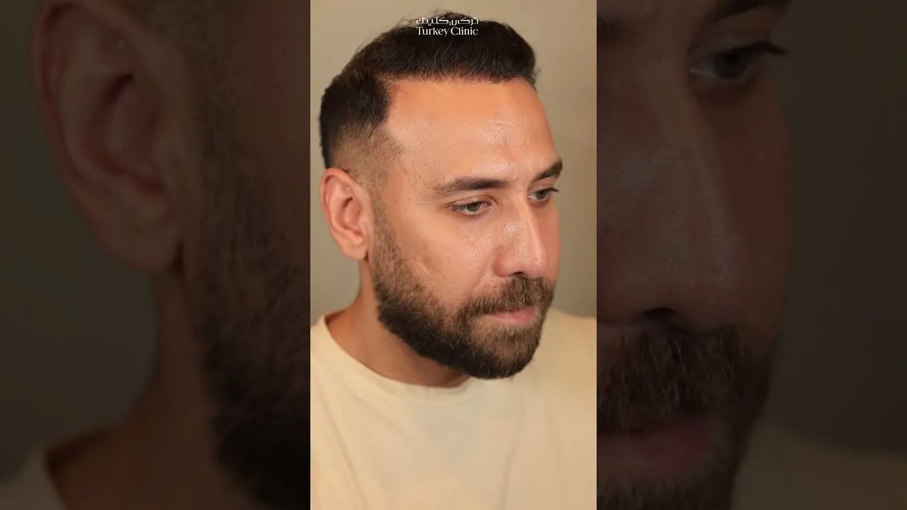 علاج الصلع من الدرجة السادسة