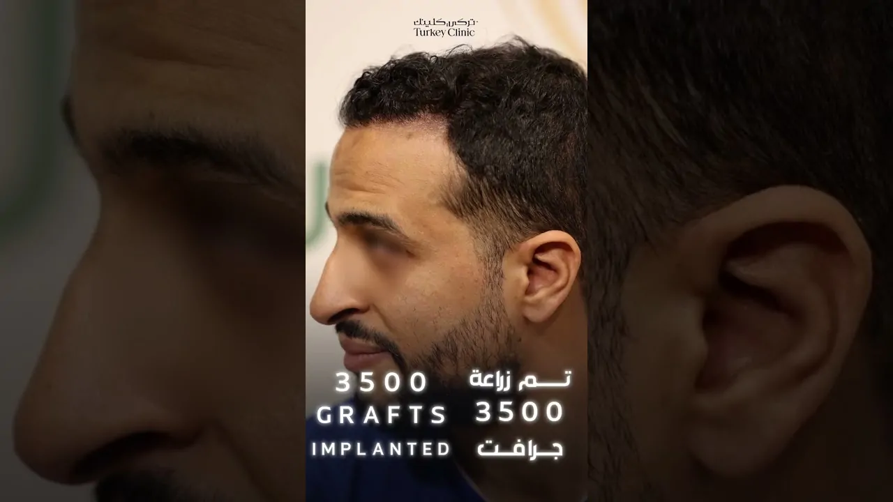 نتائج زراعة الشعر بعد 8 شهور