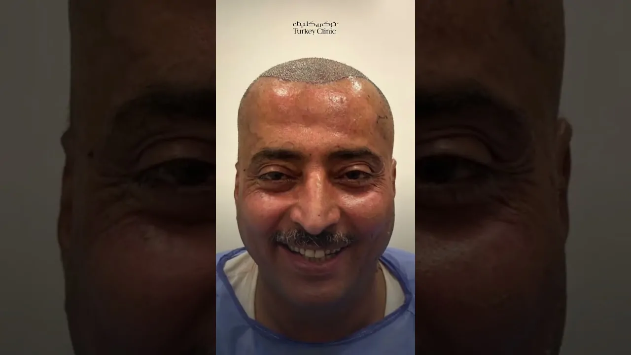 نتائج زراعة الشعر بعد سنة