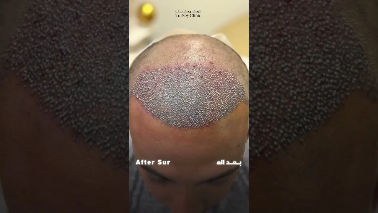 نتائج زراعة الشعر في الشهر السادس