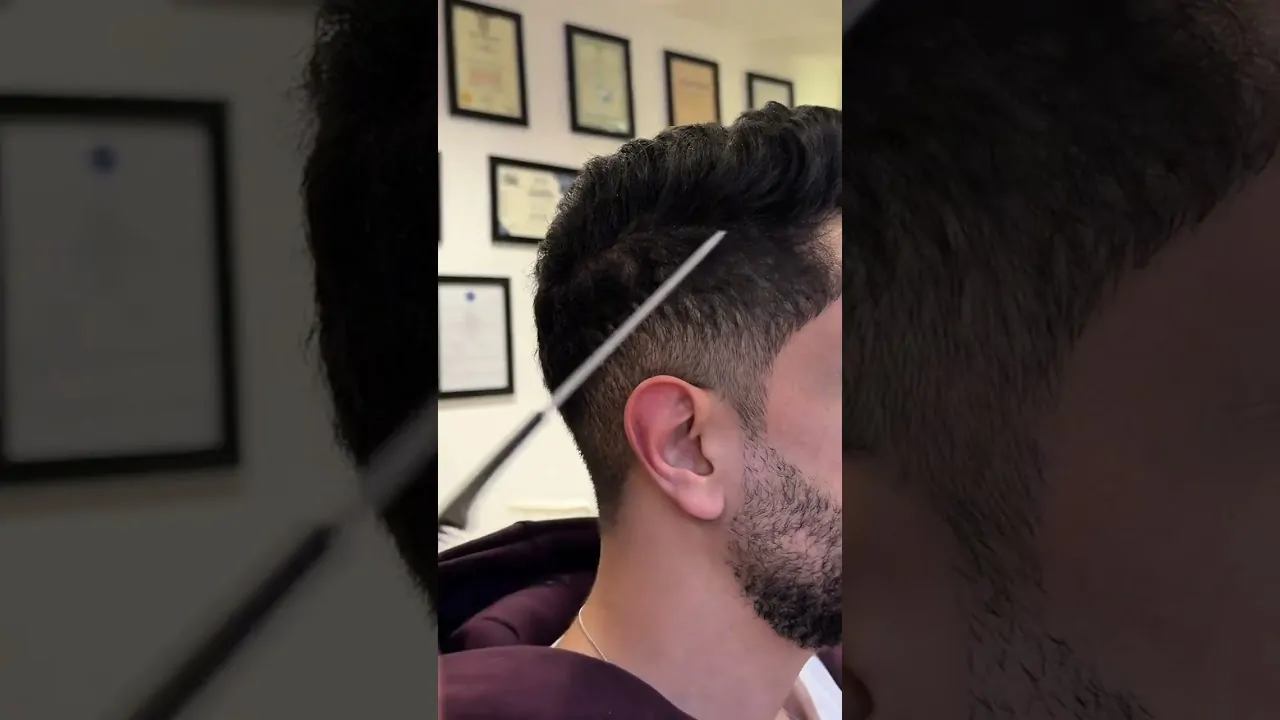 نتيجة زراعة الشعر بدون حلاقة بعد 6 شهور