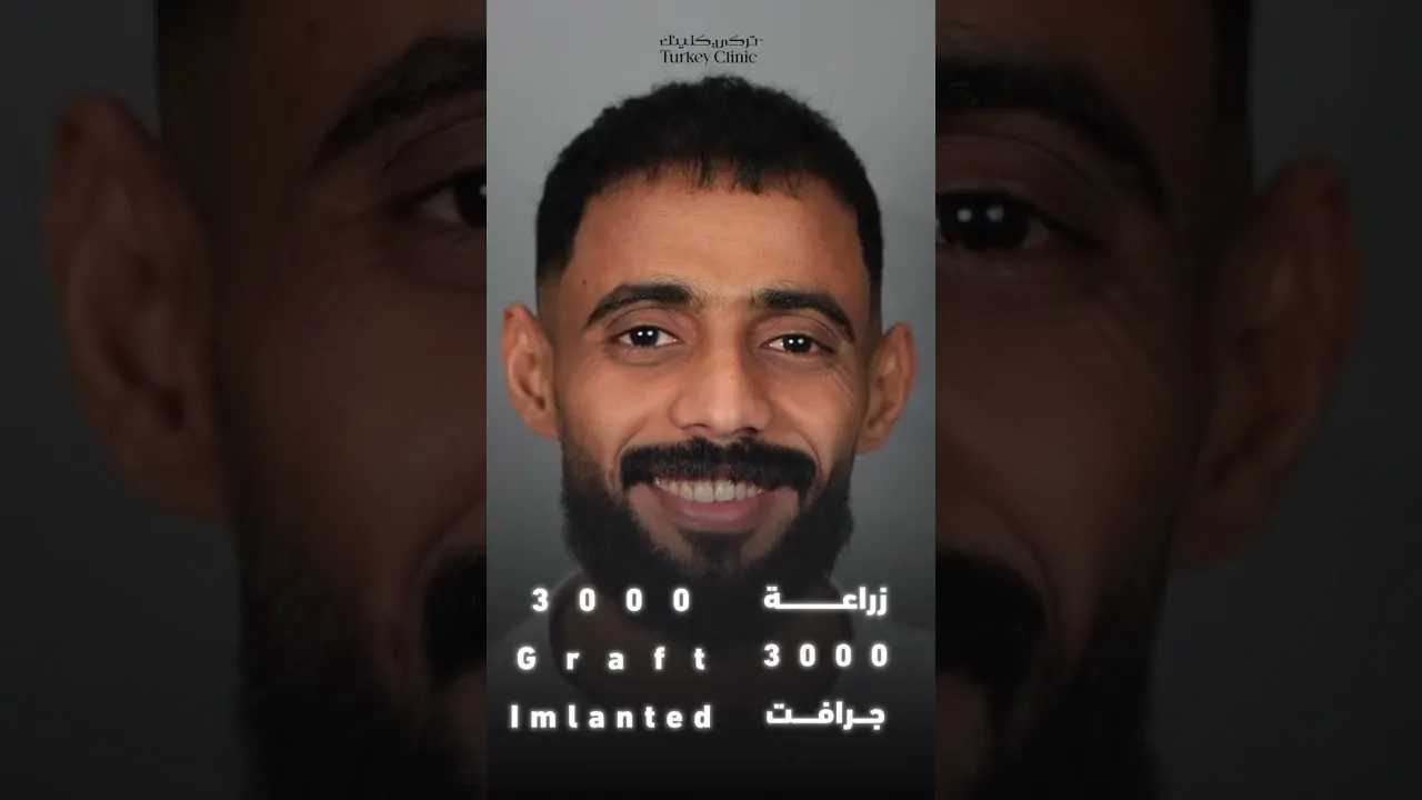 نتيجة زراعة الشعر بعد 4 شهور