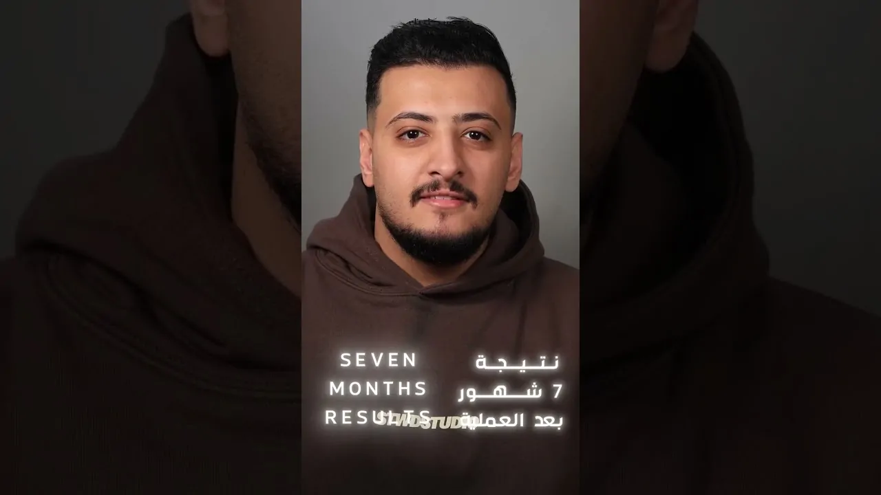 نتيجة عملية زراعة الشعر بعد 7 شهور