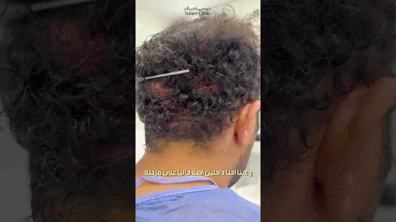 هل يمكن زراعة الشعر بدون حلاقة؟