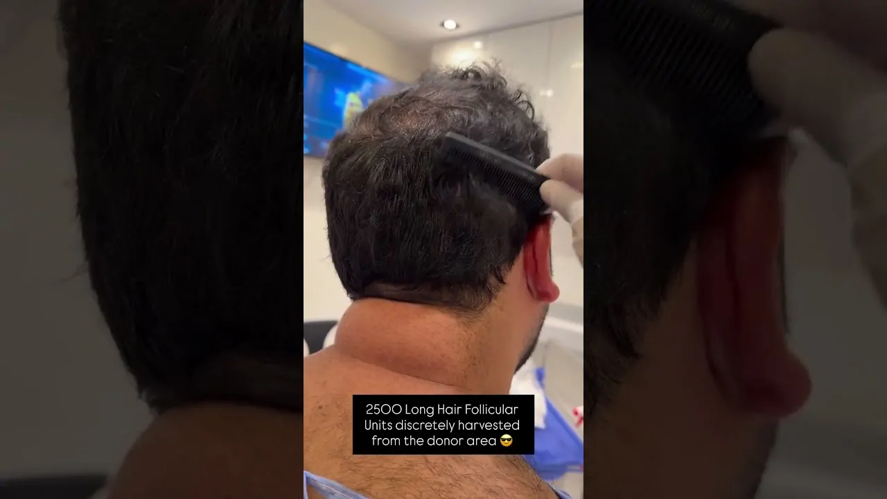 زراعة الشعر بدون حلاقة كاملة