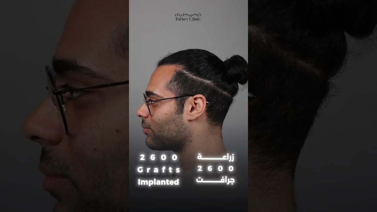 زراعة الشعر للصلع درجة خامسة