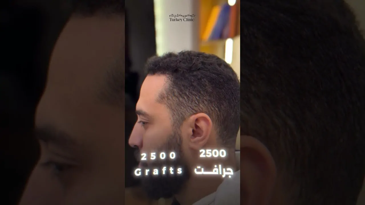 زراعة شعر للصلع الدرجة الثالثة