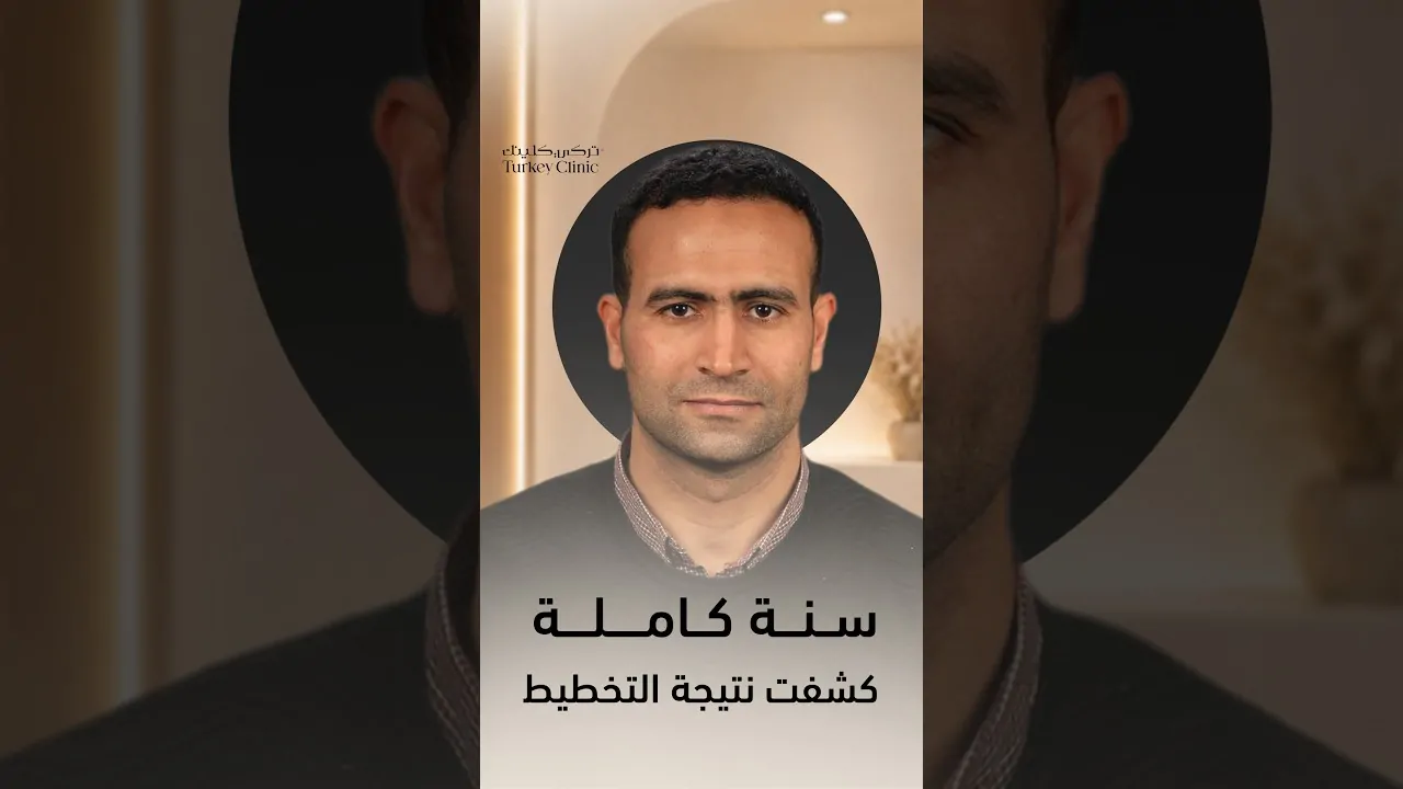 نتيجة زراعة الشعر بعد سنة
