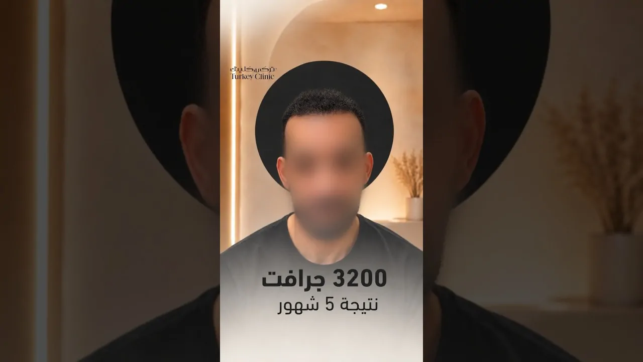 نتيجة زراعة الشعر بعد 5 شهور
